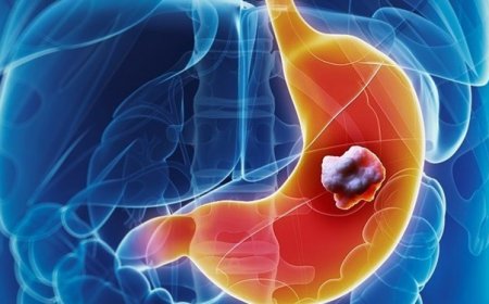 سرطان معده صدرنشین مرگ‌های سرطانی ایران