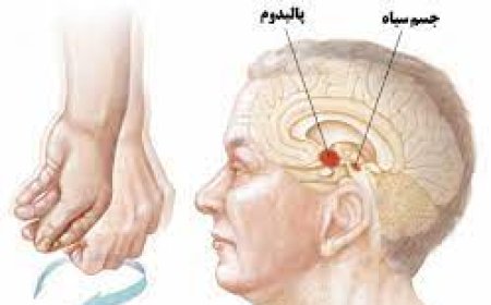 تاثیر اختلالات شناختی بر پارکینسون