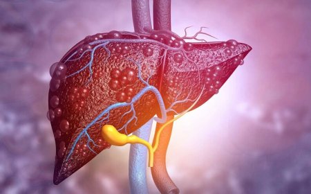 درمان خانگی کبد چرب