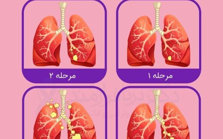 پیشگیری از سرطان ریه: راهکارهای علمی برای سلامت جامعه